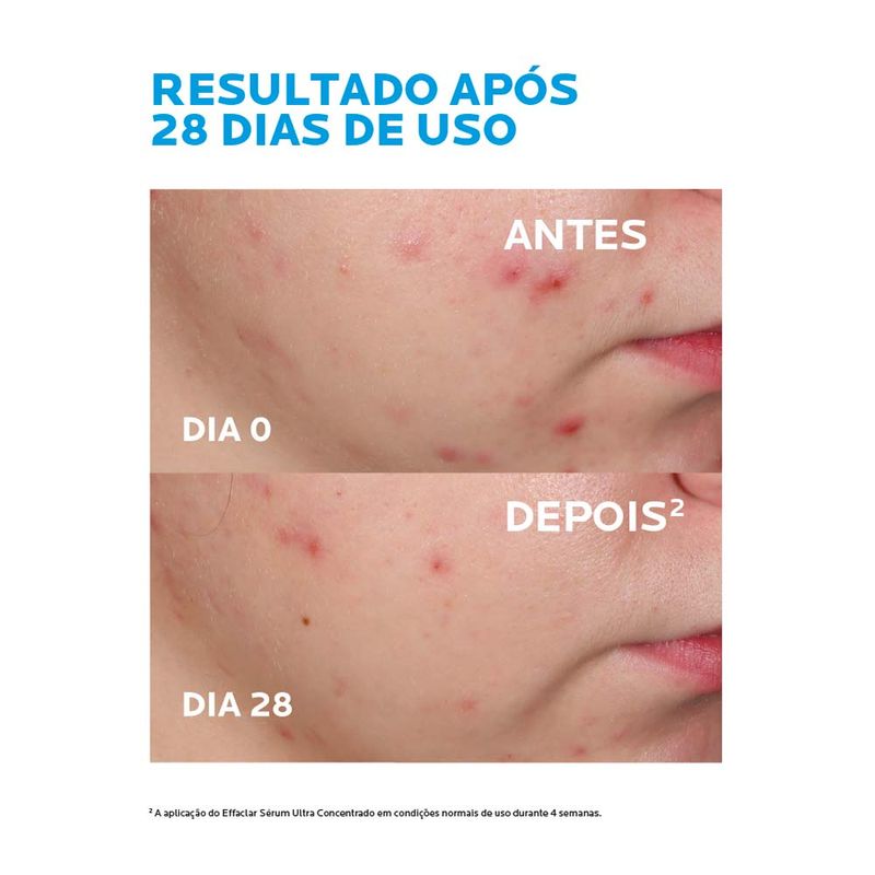 Sérum Ultra Concentrado Antiacne e Antimarcas La Roche-Posay Effaclar 15ml